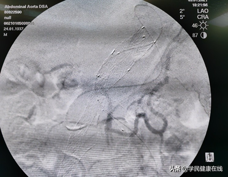 血管外科介入新技术,21世纪血管外科发展方向微创治疗