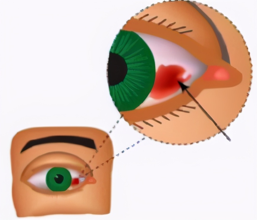 我的眼白发黄怎么回事啊,白眼球有红血丝是视网膜充血吗