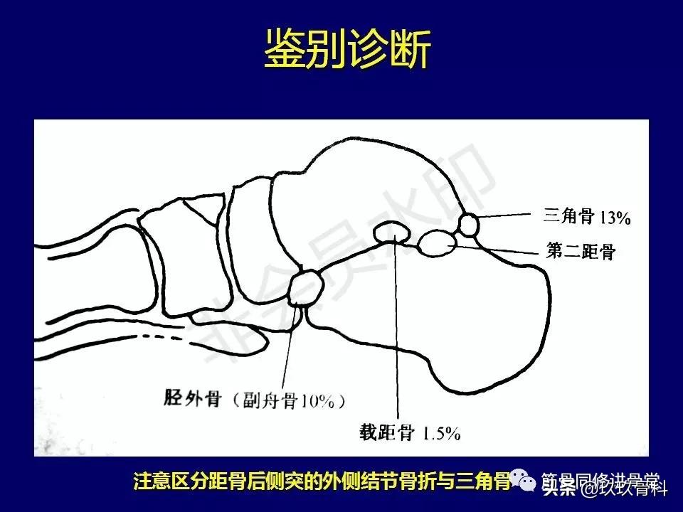 距骨骨折的治疗原则,距骨骨折如何调理