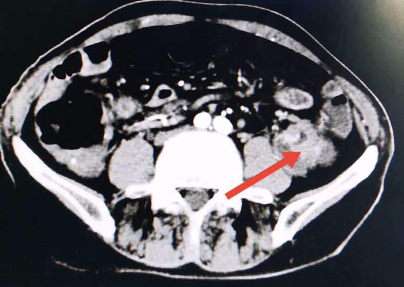 直肠癌转移肺部ct报告单怎样提示,直肠癌转移到肝肺部还能活多久