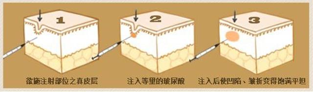 玻尿酸胶原蛋白的功效与作用,玻尿酸的功效医美