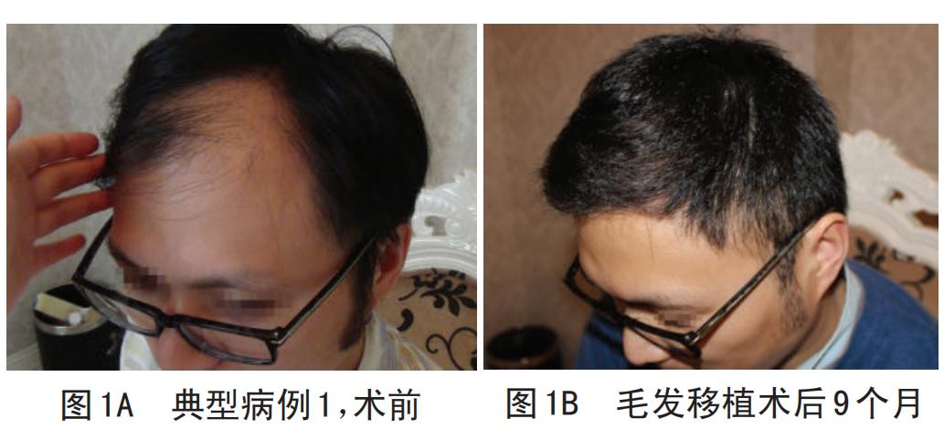 脱发秃顶严重怎么调理男,男士怎么防脱发秃顶