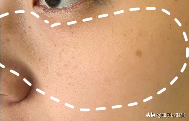 祛斑走过太多的弯路最有效的方法,祛斑最有效方法日晒斑