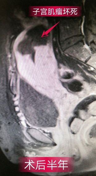 消除子宫肌瘤可用中药治疗吗,消除子宫肌瘤的特效药