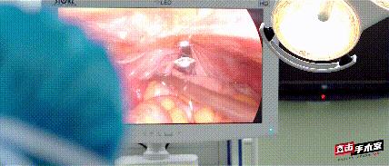 女子突然肚子疼手术,深圳女子突然肚子疼