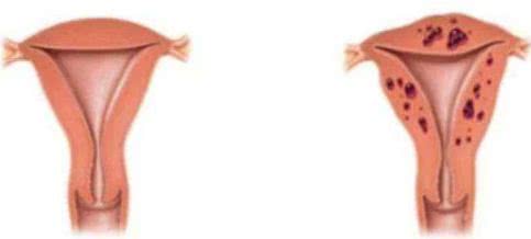 子宫腺肌瘤绝经后怎样,腺肌症多大年龄能绝经