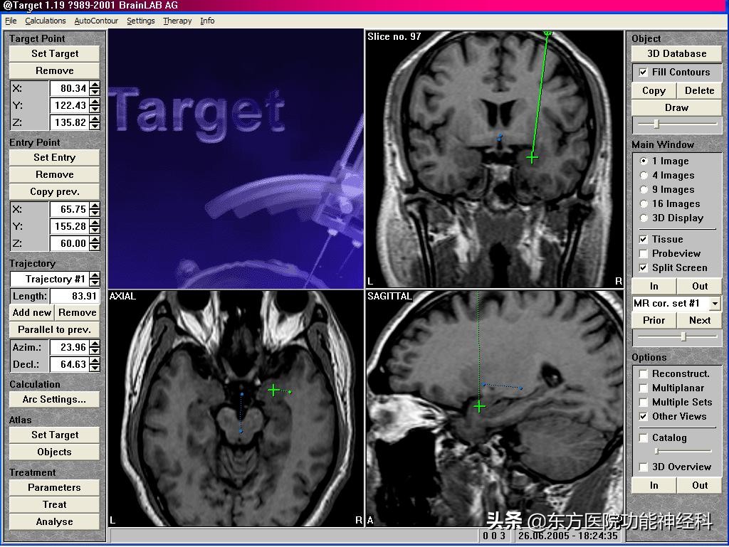 癫痫病微创手术可靠吗,癫痫病做微创手术能治愈吗