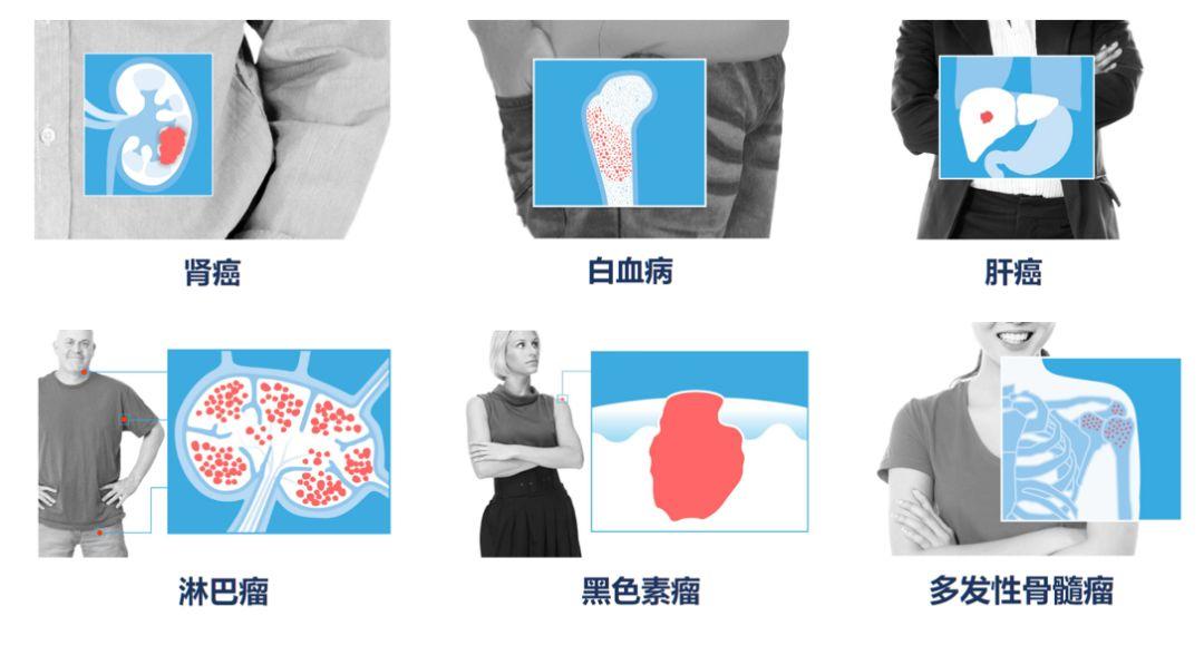 最新科研进展nk免疫细胞治疗癌症,抗癌药物组合物