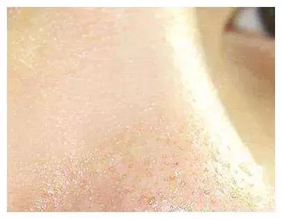 万年毛孔去不掉？那是你没用对方法