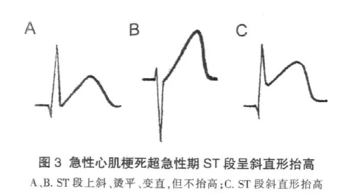 这几种疼痛竟预示着心梗,闻所未闻的病