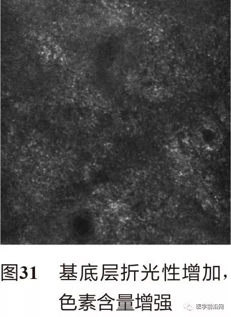 皮肤共聚焦显微镜能查什么,皮肤镜和共聚焦显微镜