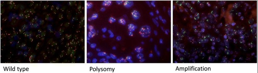 肺癌罕见突变,met14突变肺癌临床数据