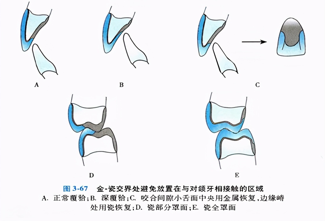 口腔金属冠与全瓷冠的区别,牙科医生讲义
