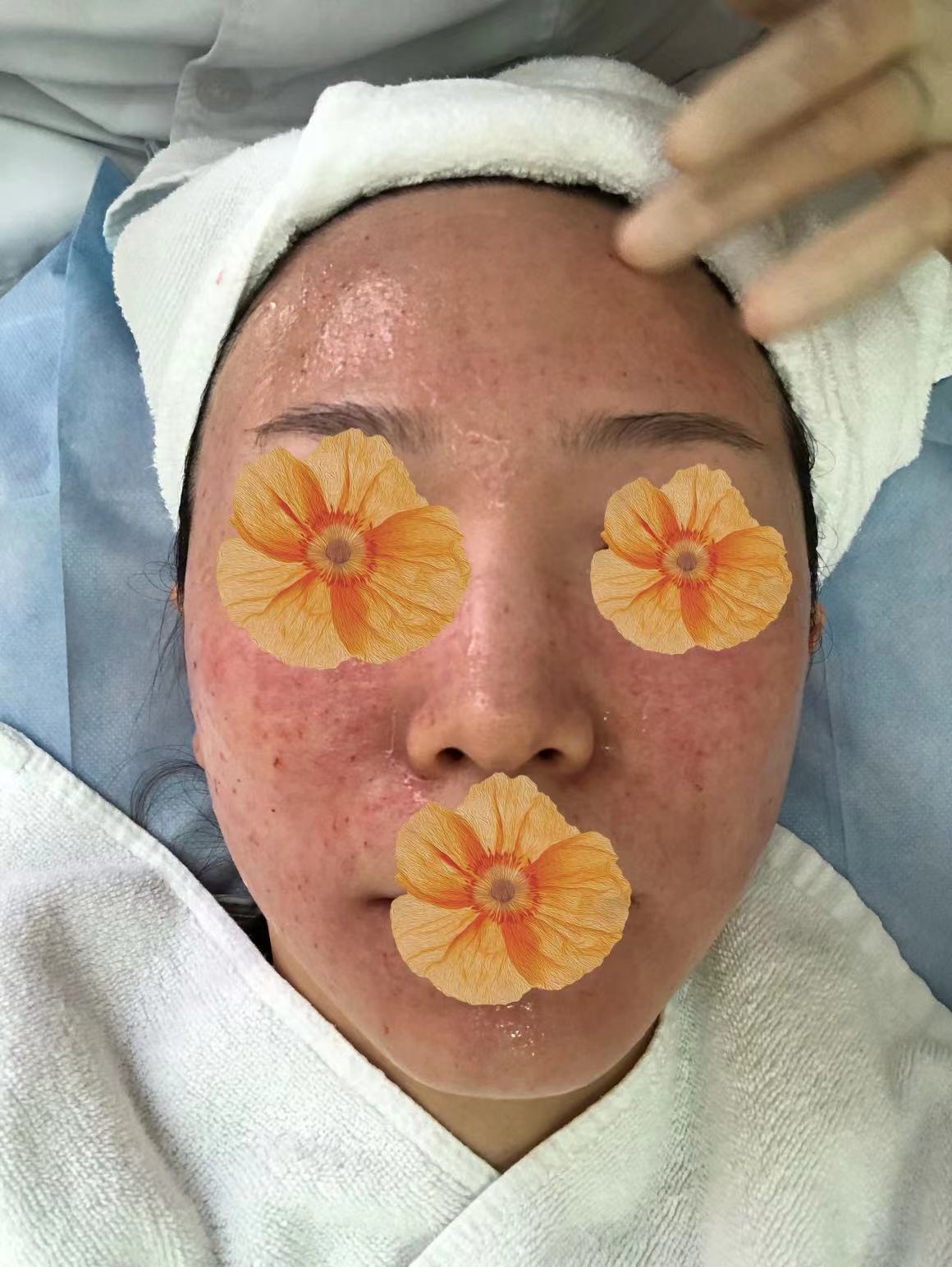 我的医美笔记-水光针