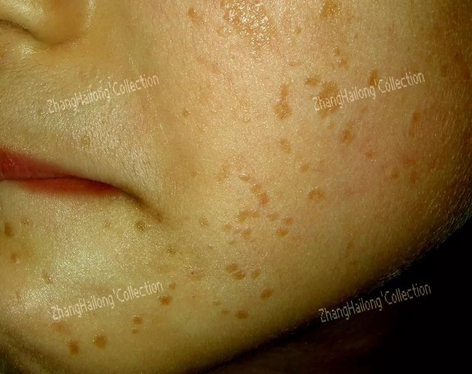 为什么会长瘊子,脚底为什么会长瘊子