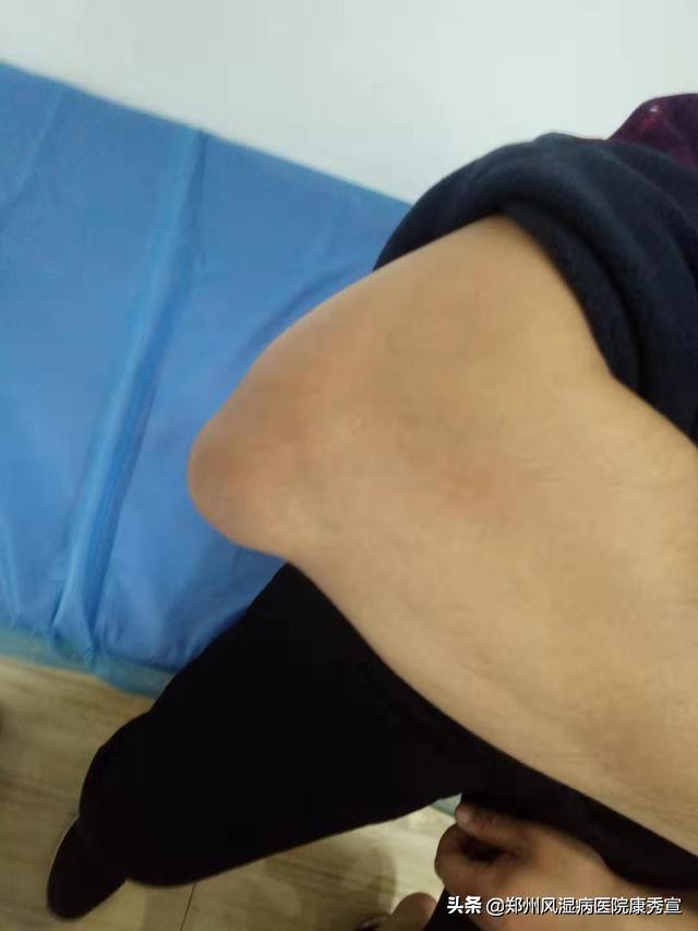 痛风发作怎么可以快速缓解,痛风突然发作怎么样可以马上止痛