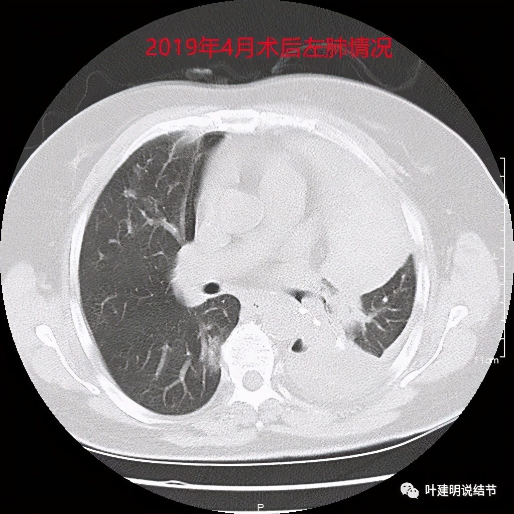 左肺癌手术半年右肺下角还有炎症,左下肺癌晚期