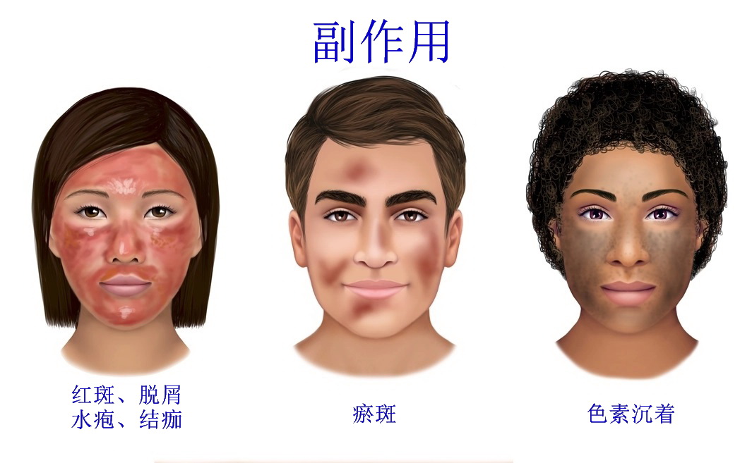 照光治疗痤疮有效果吗,激光能治疗痤疮吗