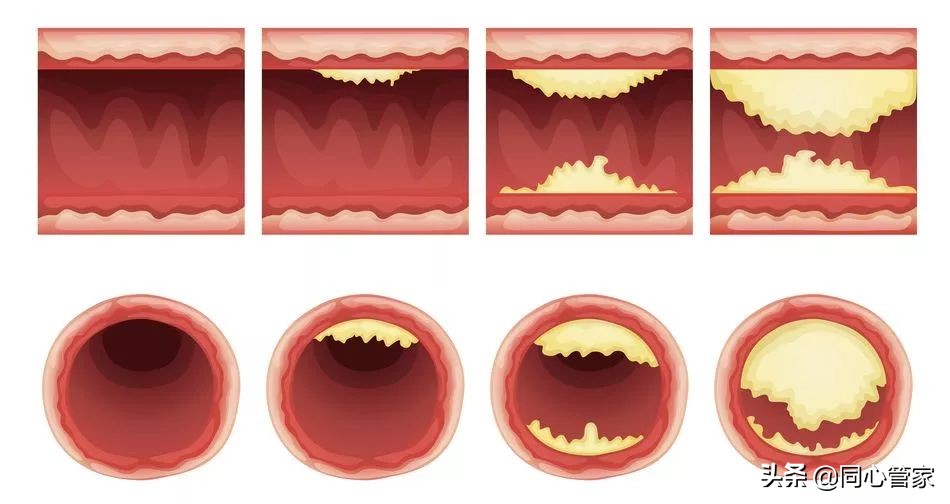 血管狭窄如何扼住生命的咽喉?让你全身器官都遭殃