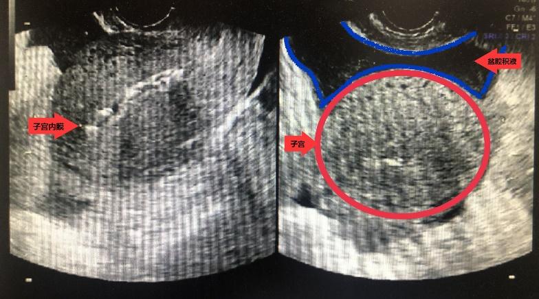 盆腔积液中医怎么治疗,中医怎么治疗盆腔积液