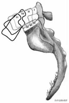 腰痛是不是因为驼背,腰两侧椎弓崩裂什么引起的