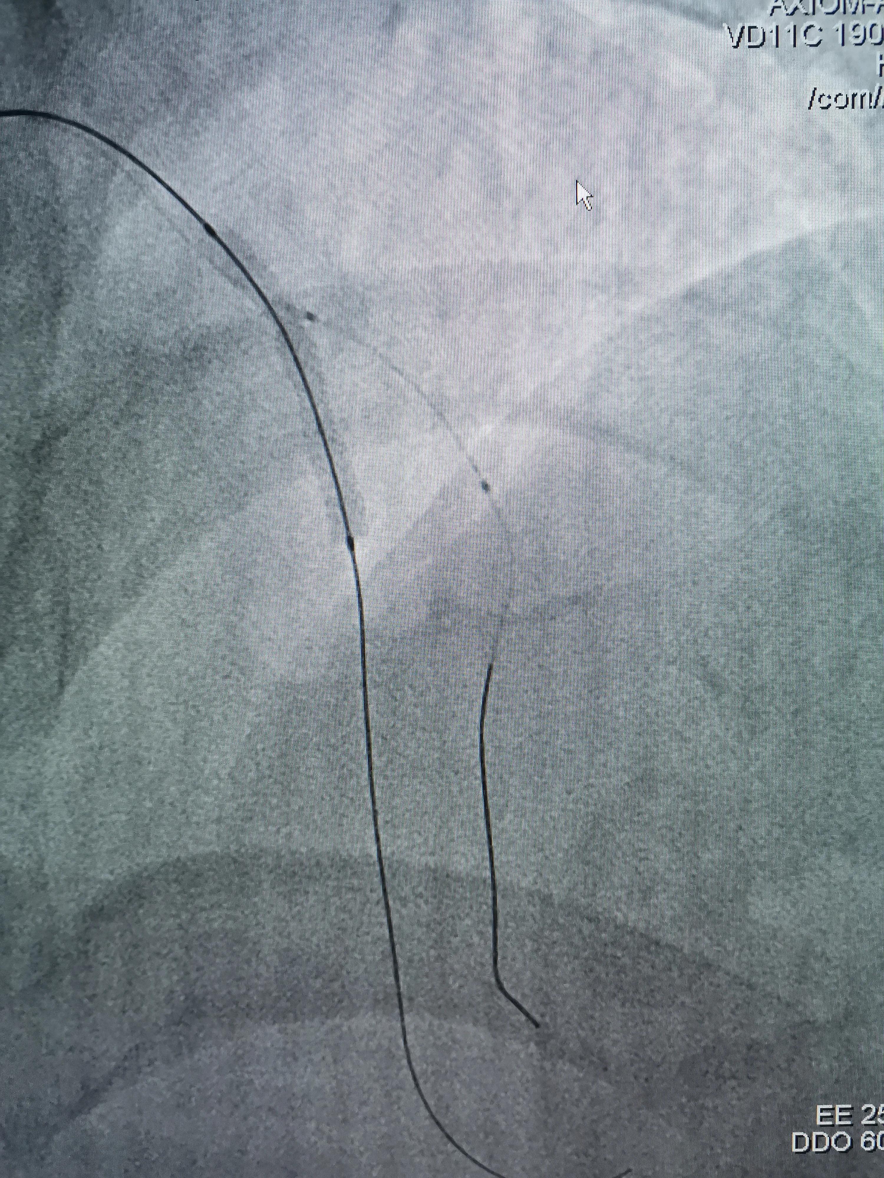 atp术式治疗冠脉分叉病变,冠脉分叉处堵塞能治吗