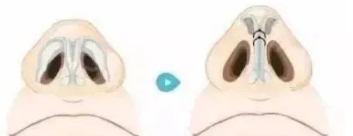 经常挖鼻孔导致鼻孔大怎么改善,酒糟鼻会导致鼻孔过大吗