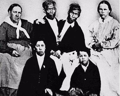 中国连体双胞胎兄弟,连体兄弟中国