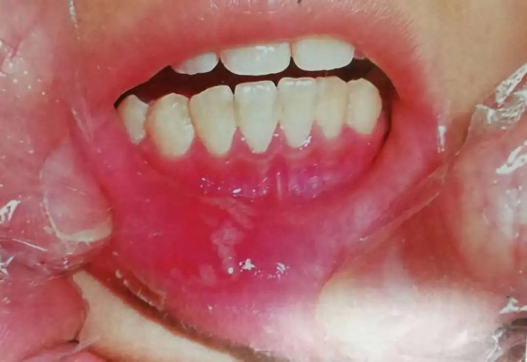 7岁宝宝嘴唇溃疡一大片，原因竟然是这个！#雅悦齿科#