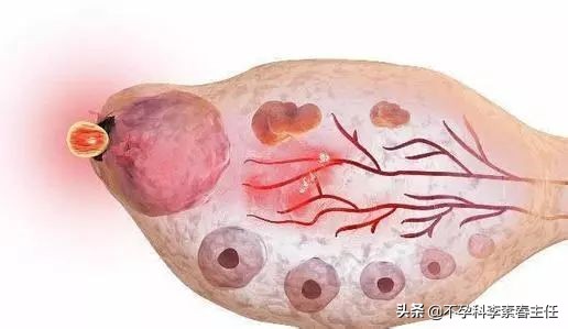 多囊卵巢综合征怀孕后注意事项,多囊促排怀孕后需要注意什么