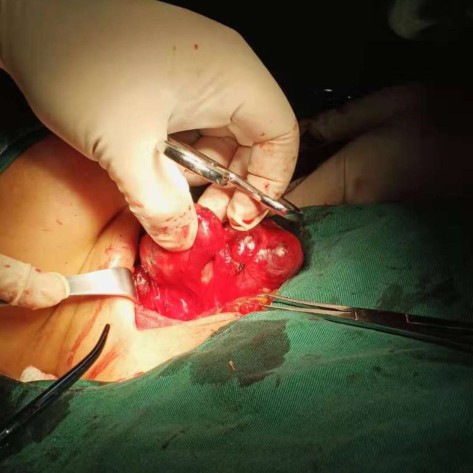 阑尾切除手术费用多少钱,阑尾切除手术记录模板