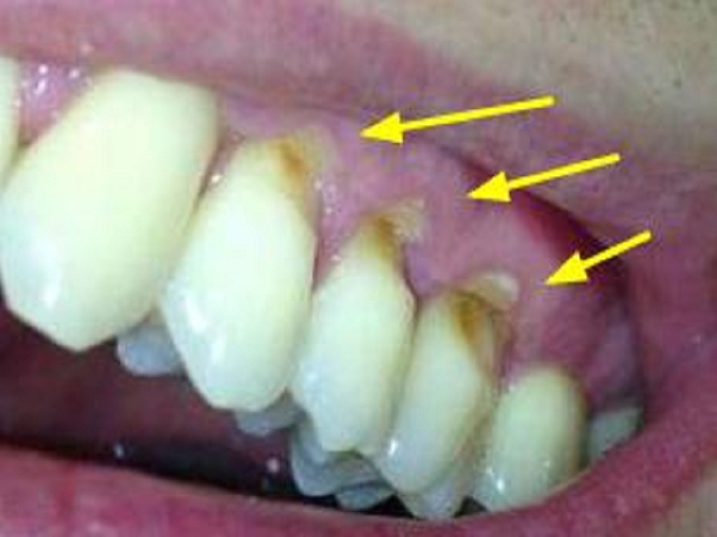 不正确的刷牙多久会形成楔状缺损,不正确的刷牙方式导致牙根外露