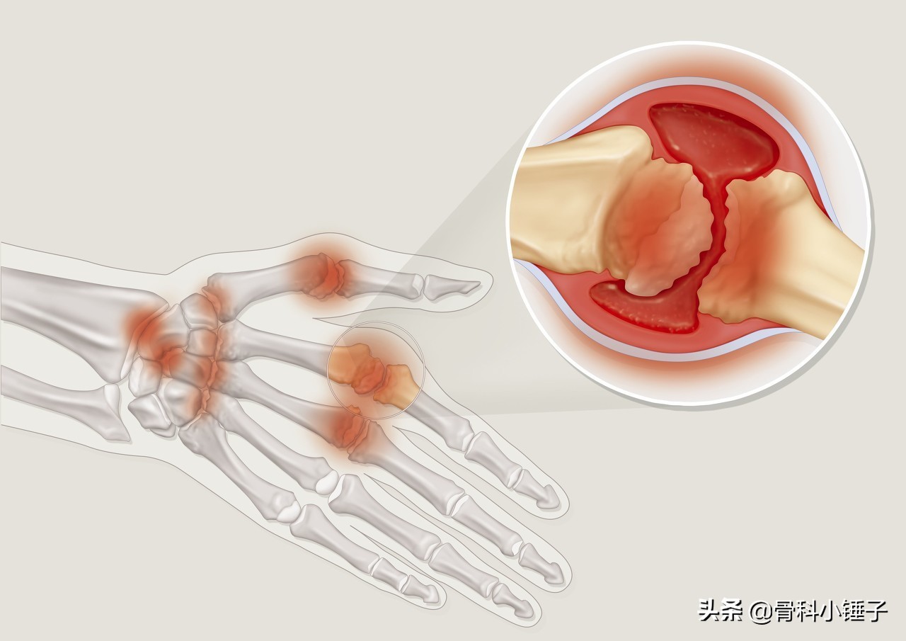 风湿病用什么方法治疗最有效,风湿病的治疗方法