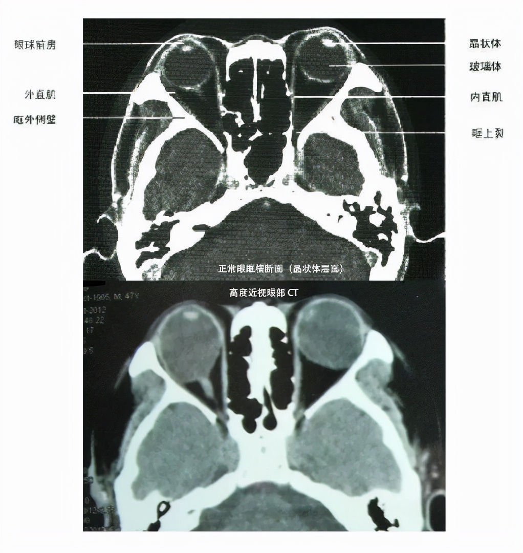 十三岁高度近视能做巩膜加固术吗,后巩膜加固术提高视力