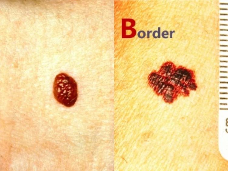 激光点痣不小心照了紫灯怎么办,切除黑色素痣可能癌变吗