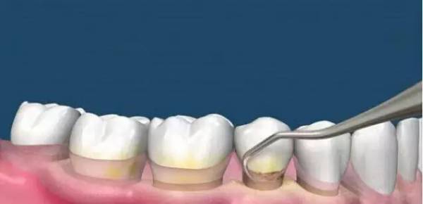 洗牙到底怎么洗好,洗牙洗的不干净