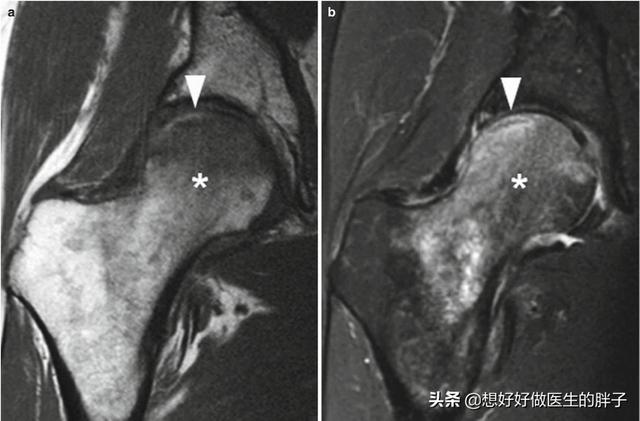 髋关节疼痛会引起腿痛吗,髋关节疼痛两腿不一样长如何康复