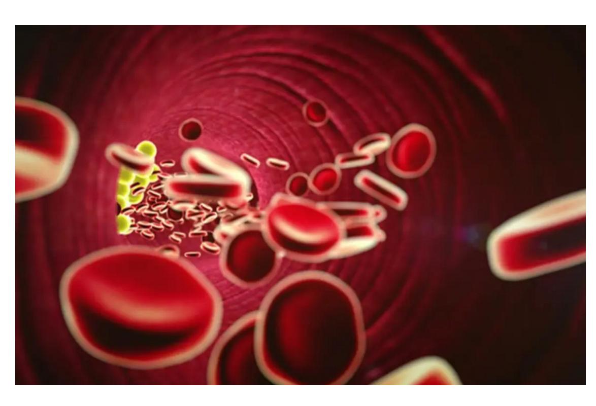 孕期检查脂蛋白高怎么办,如果孕期查出溶血症能治疗吗