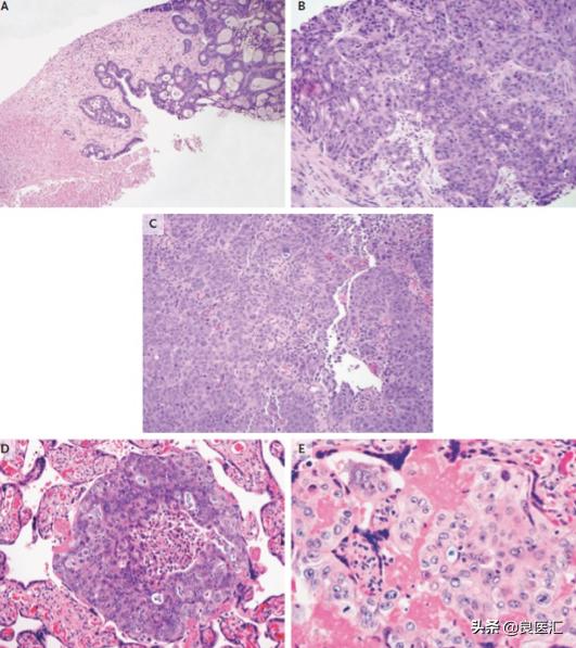 NEJM病例：36岁孕妇，诊断腺癌