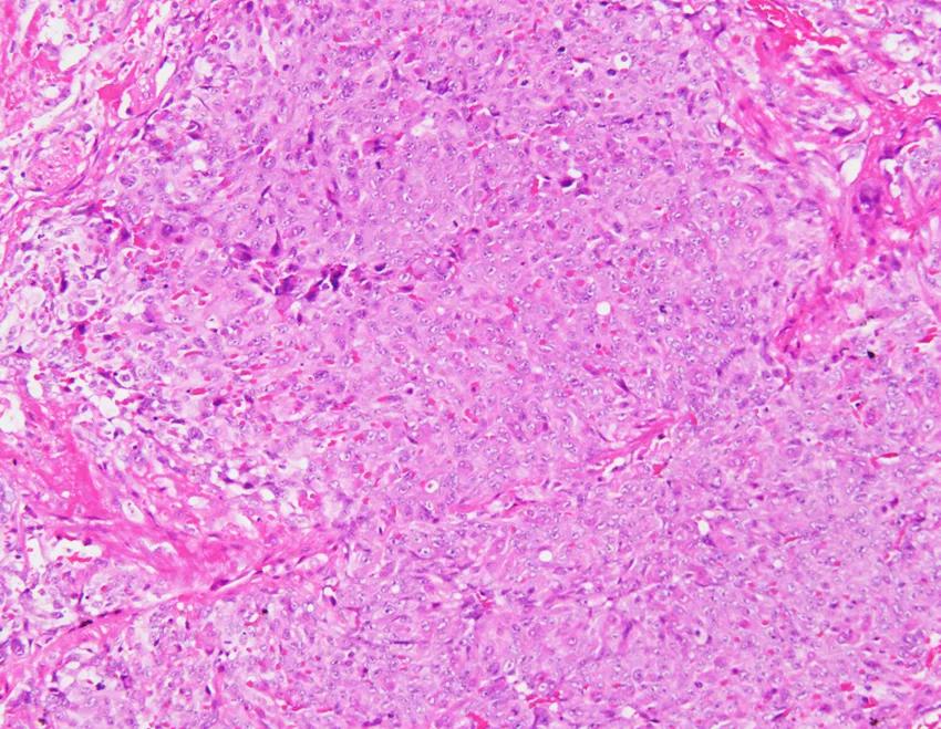 弥漫性肺泡出血是怎么回事,弥漫性肺泡出血症病因分类