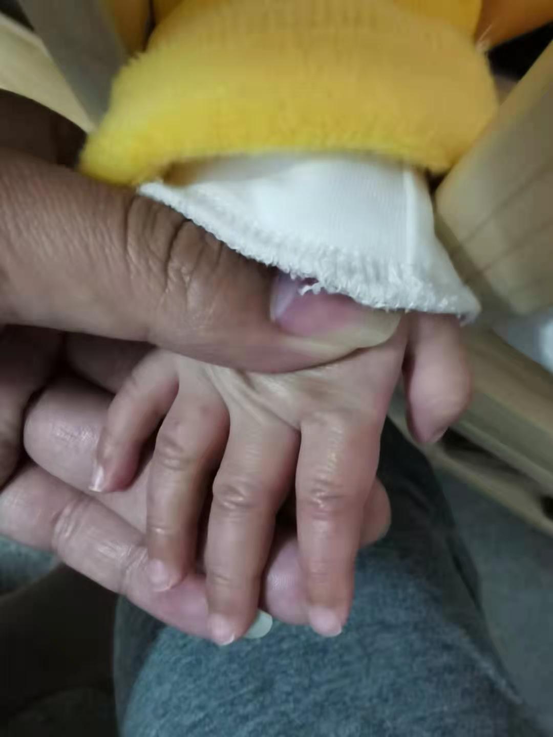 孩子的手过敏红肿怎么办,五个月宝宝手红肿了怎么回事