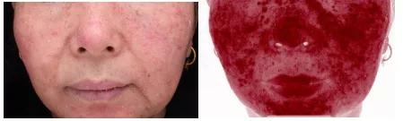 脸又痒又红又起痘,敏感皮肤脸发红发烫怎么办