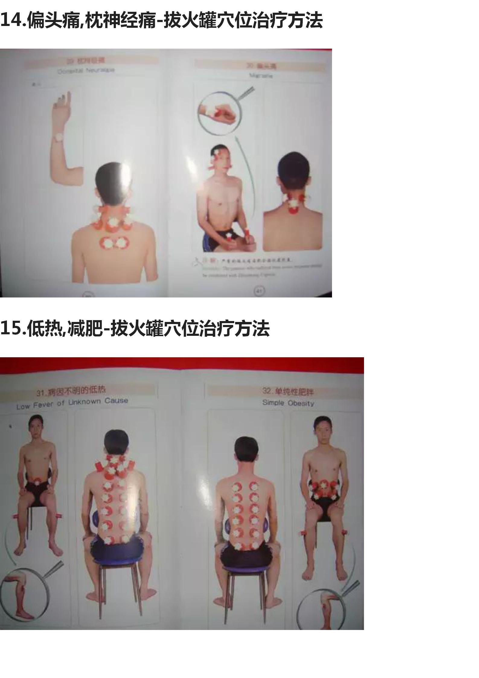 拔罐的手法和穴位图,中医拔罐穴位图片及作用