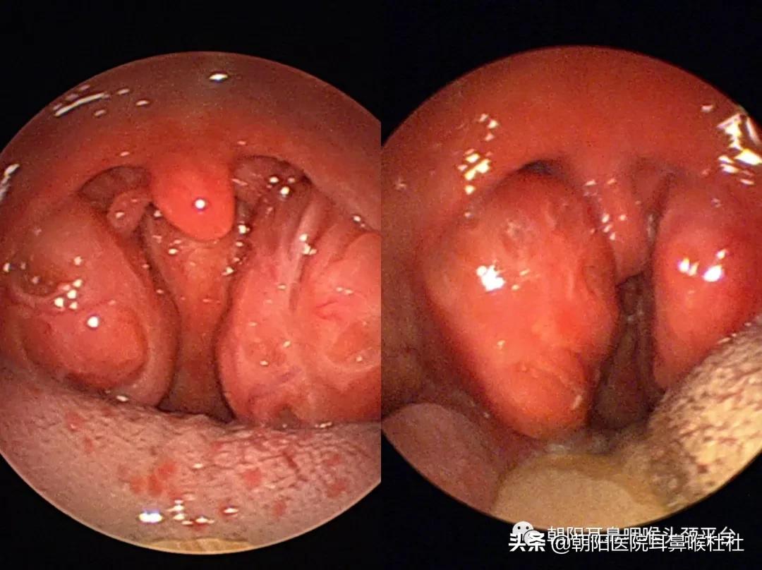 得了扁桃体癌的时候扁桃体红吗,扁桃体癌或扁桃体恶性淋巴瘤