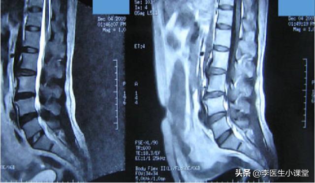 腰椎间盘突出腿疼没劲怎么办,一走路就腿疼无力怎么回事