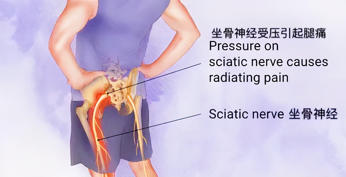 出现下肢疼痛、麻木就是腰突了？医生辟谣，带您了解梨状肌综合征