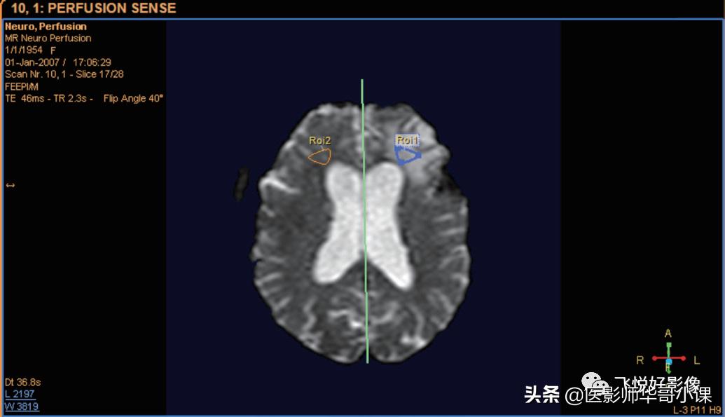 飞利浦磁共振脑灌注怎么测量,飞利浦核磁诊断教学