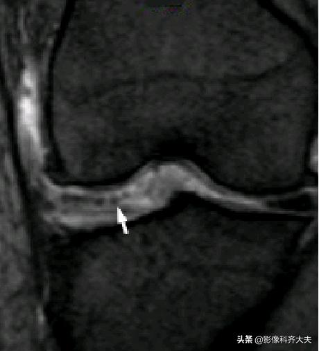 膝关节半月板损伤的磁共振,膝关节半月板病变的mri诊断与鉴别