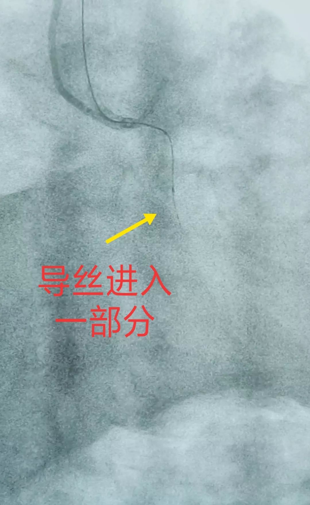 心血管严重堵塞不能放支架怎么办,心血管完全闭塞支架失败