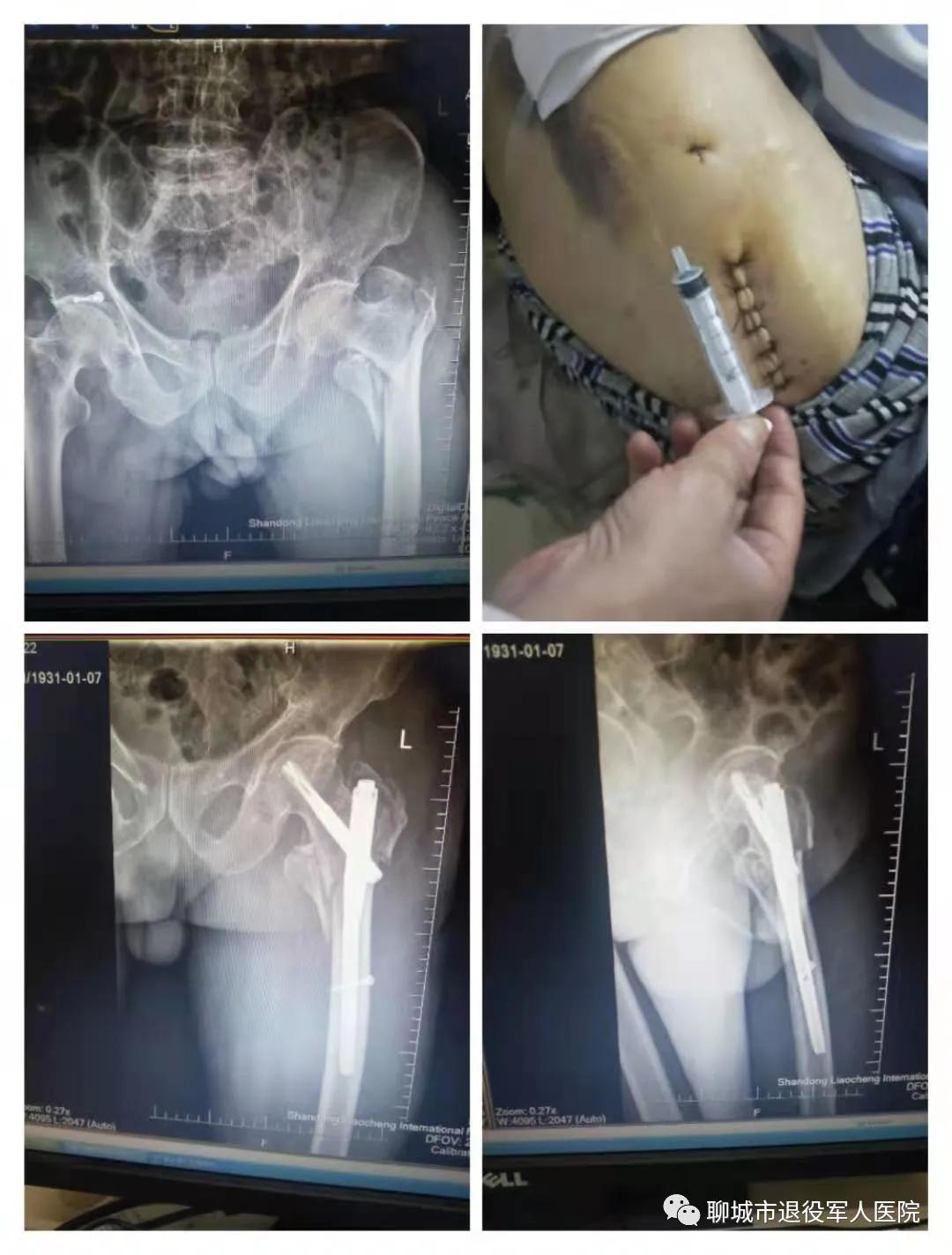 人生的最后一次骨折护理,医生说人生最后一次骨折